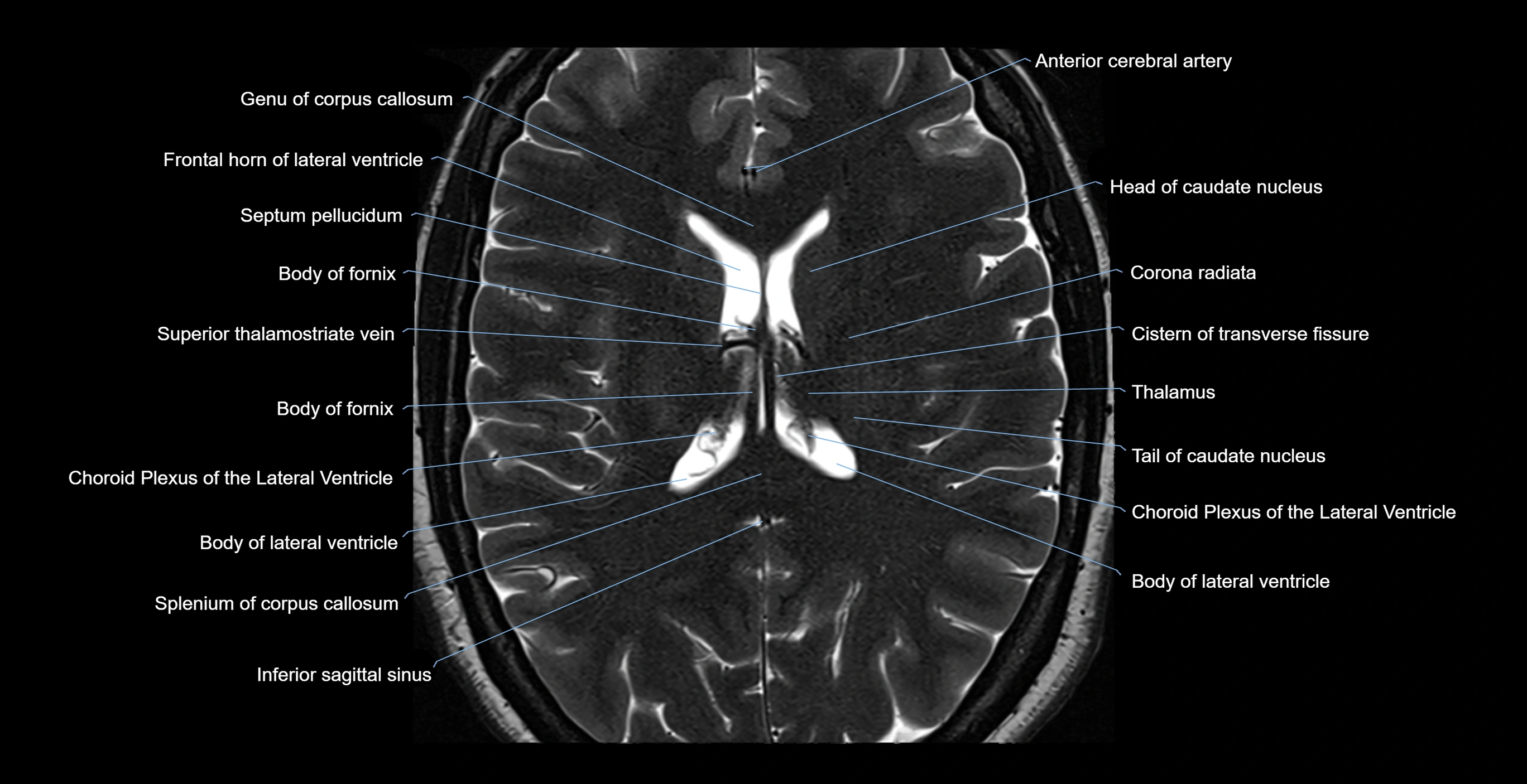 brain axial anatomy 3T MRI images -img-17001-00039.webp